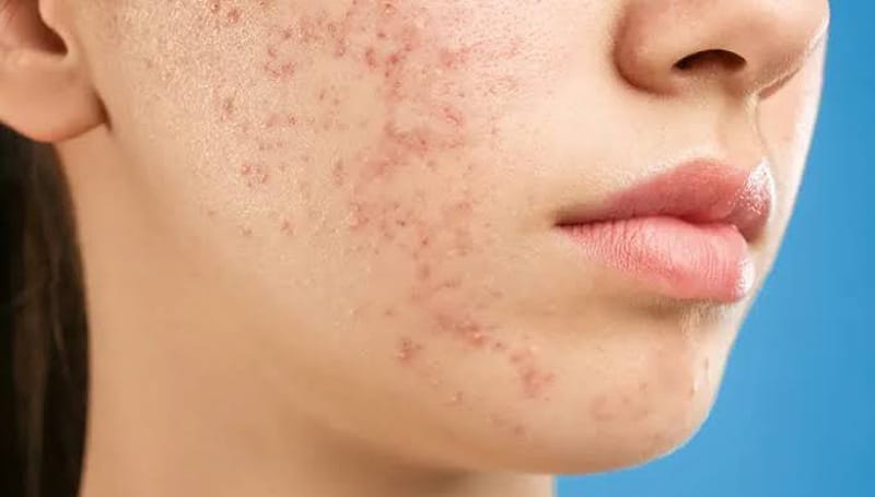 Cara Menghilangkan Jerawat dengan Mudah dan Cepat