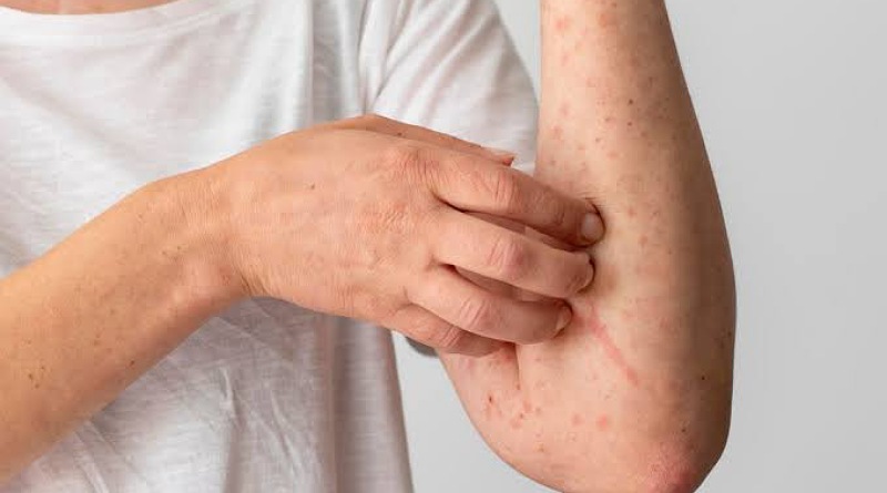 Penyakit Lupus: Penyakit Autoimun yang Menyerang Berbagai Organ dan Jaringan dalam Tubuh