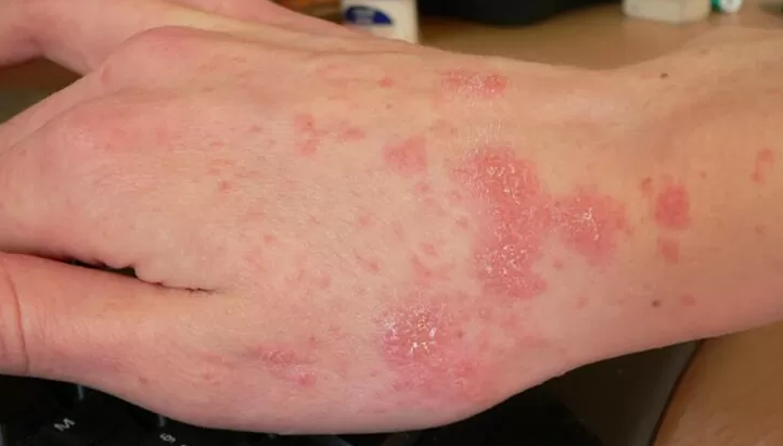 Peningkatan Kasus Kudis di Inggris: Masyarakat Diimbau Waspada Terhadap Ruam Gatal